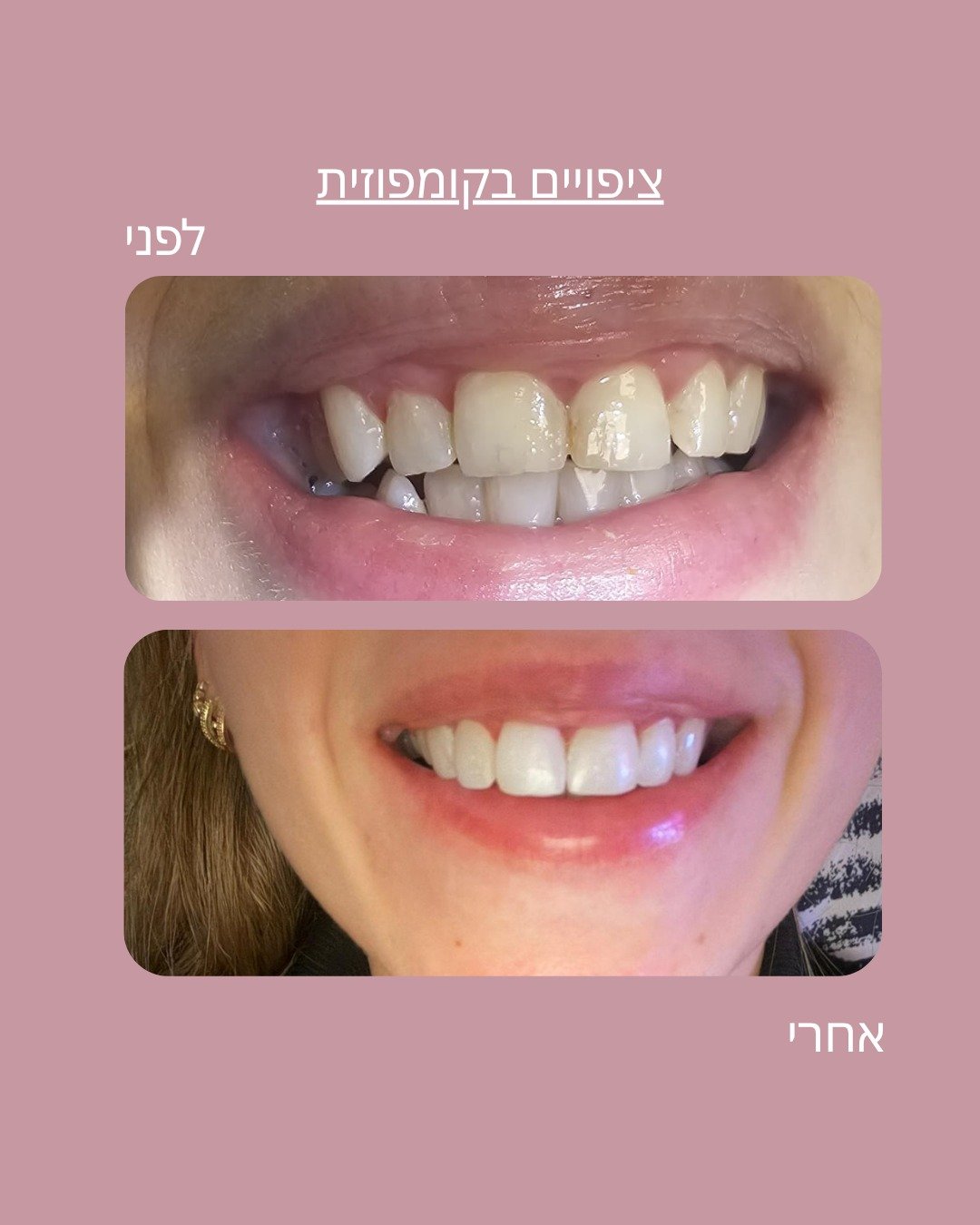 לפני ואחרי ציפויים בקומפוזית על השיניים הקדמיות, מקרה מהמרפאה