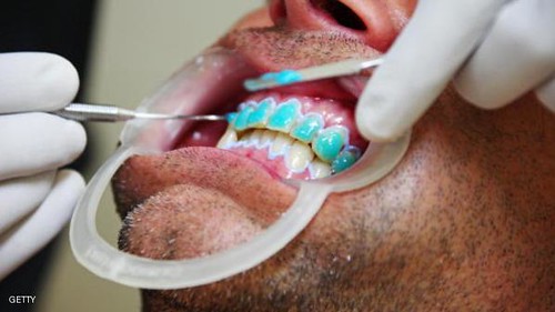 הלבנת שיניים — מרפאת ביוטק סמייל בהרצליה הלבנת שיניים — מרפאת ביוטק סמייל בהרצליה